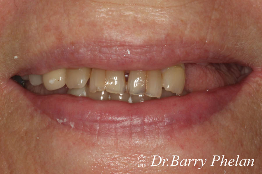 Pre-Mouth-Rehabilitation-with-Implant-Supported-Bridges-and-Veneers