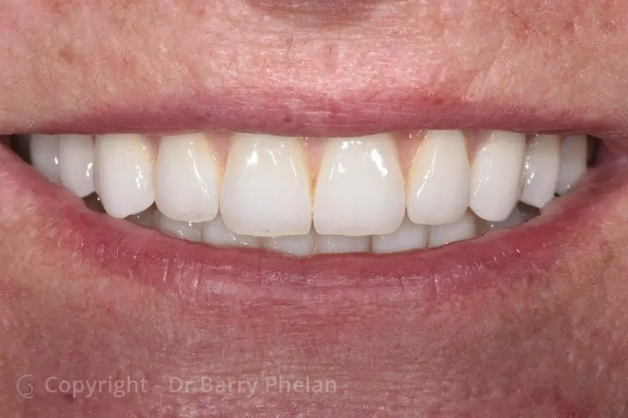 Full Mouth Reconstruction with Upper and Lower Fixed Bridges Supported by Implants