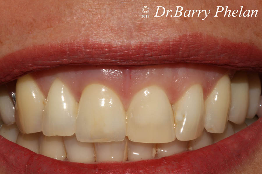 Ceramic-Crown-fitted-to-implant-3-months-after-placement