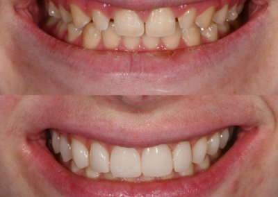 Full Mouth Rehabilitation with Implant Supported Bridges and Veneers
