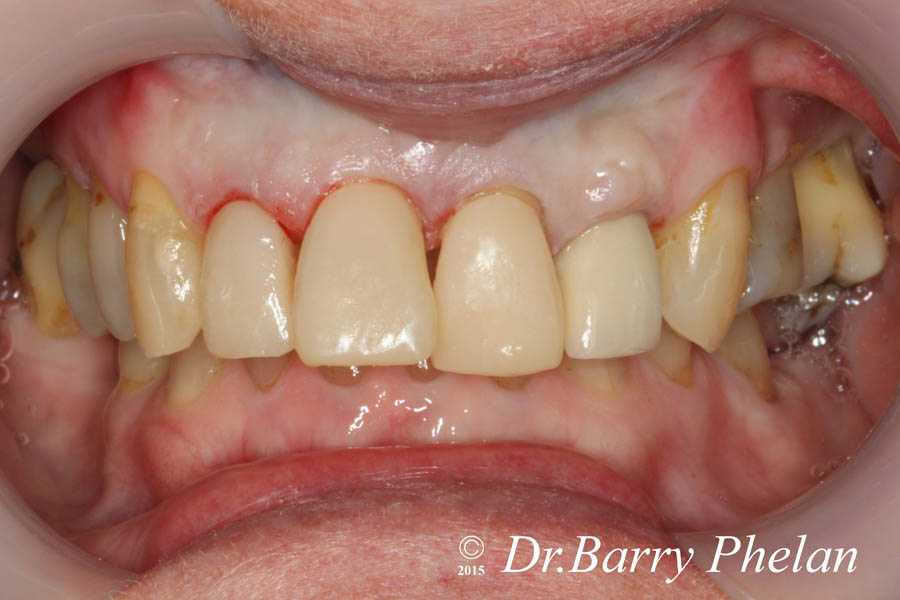 Full Mouth & Smile Rehabilitation with Orthodontics, Implants