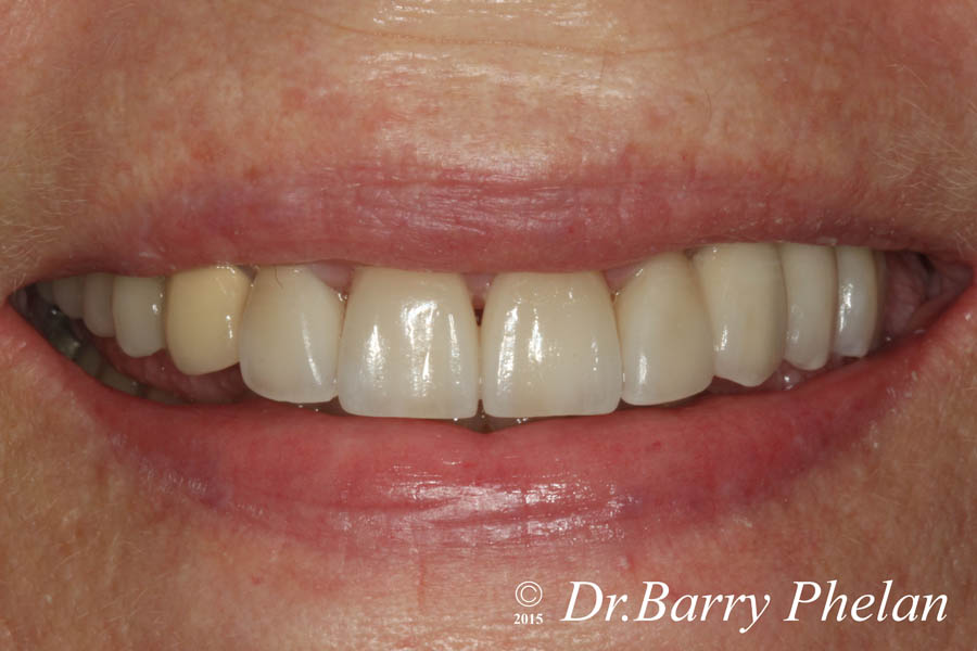 Post-Rehabilitation-with-Combination-of-Ceramic-Veneers-on-the-front-4-teeth-with-Implant-supported-3-unit-bridge-on-the-upper-left