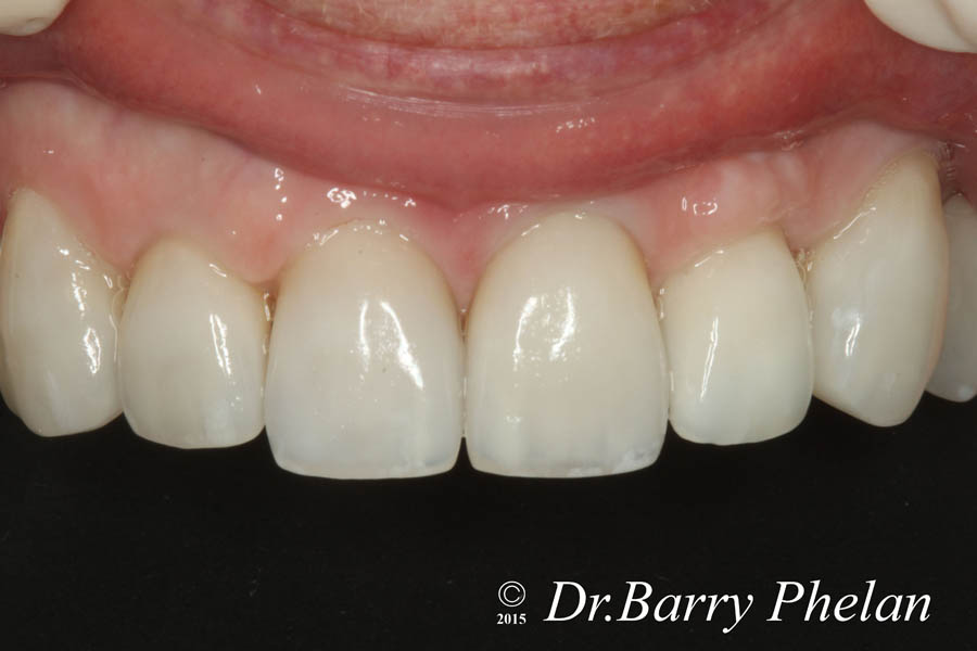 Natural-Colour-and-characterisation-of-Ceramic-Crowns