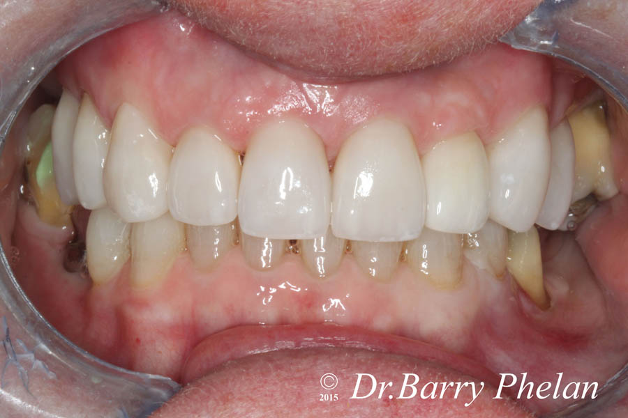 One-week-post-cementation-of-upper-ceramic-crowns-and-veneers-prior-to-placement-of-implant-crowns-on-the-lower-back-areas-to-improve-back