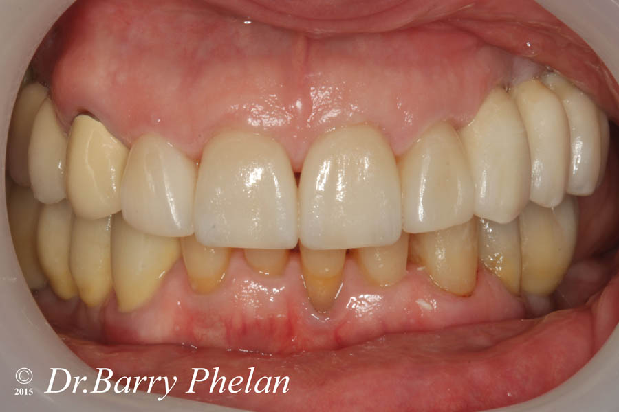 Implant-supported-fixed-crowns-and-bridges-fitted-on-the-lower-left-and-right-resprectively