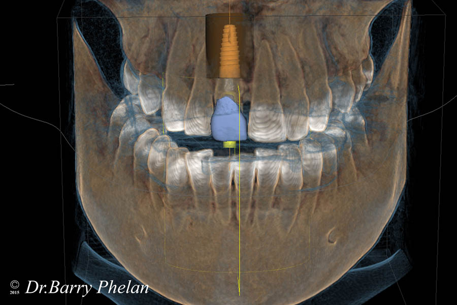 Virtual-implant-planning-using-Integrated-Conebeam-xg3d-and-Intraoral-3d-scannin-cerec-Omnicam