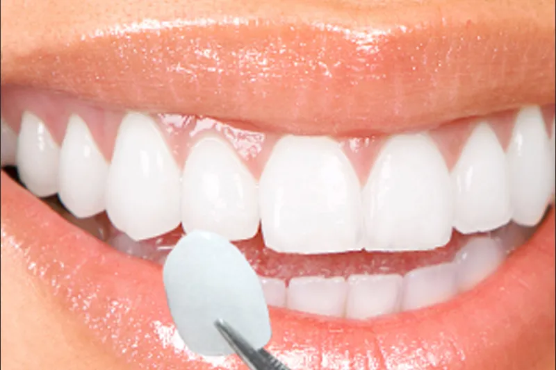 Resin Veneers to correct wear from Bruxism