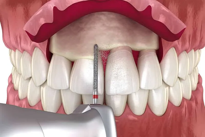Smile Rehabilitation with Implant Therapy, Crown Lengthening