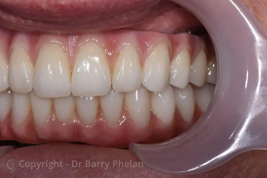 Full Mouth Reconstruction with Upper and Lower Fixed Bridges Supported by Implants