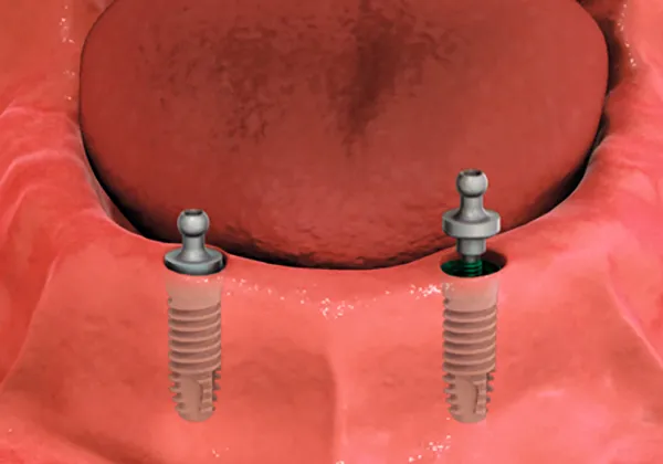 Implant Supported Dentures - 2