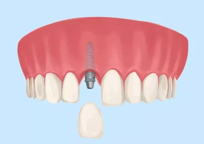 Immediate Implant to Replace Central Incisor