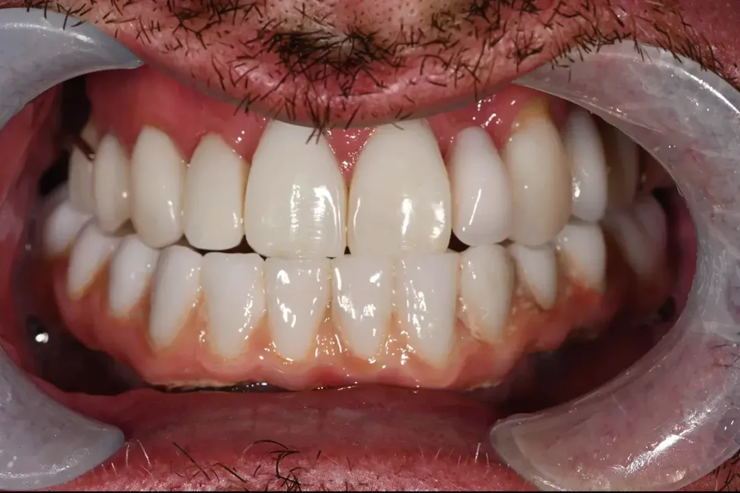 Case Study – Resin Veneers + Partial Denture