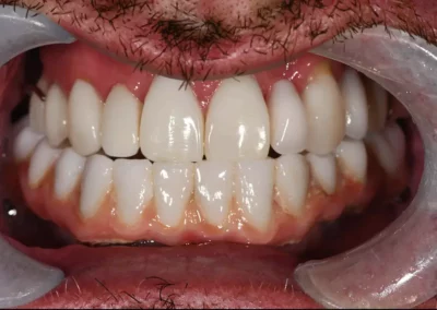 Case Study – Resin Veneers + Partial Denture