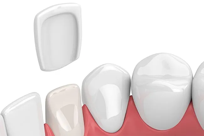 Porcelain veneers are made of ultra-thin ceramic porcelain