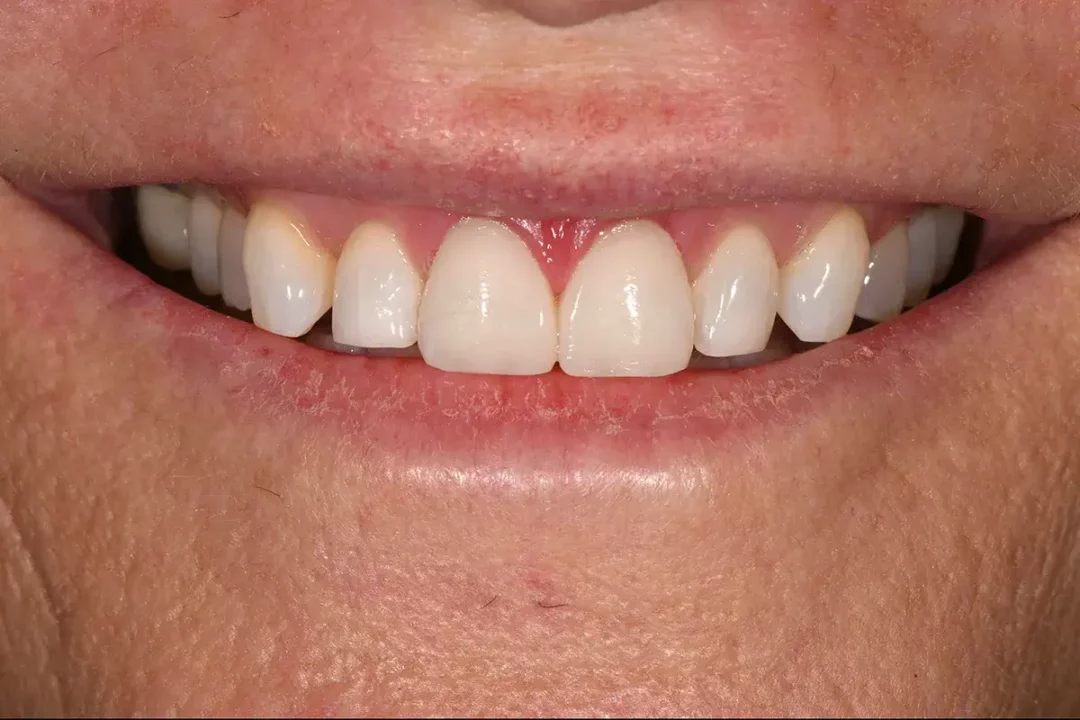 Resin Veneer – Case Study