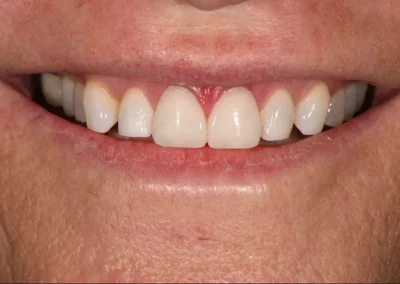 Resin Veneer – Case Study