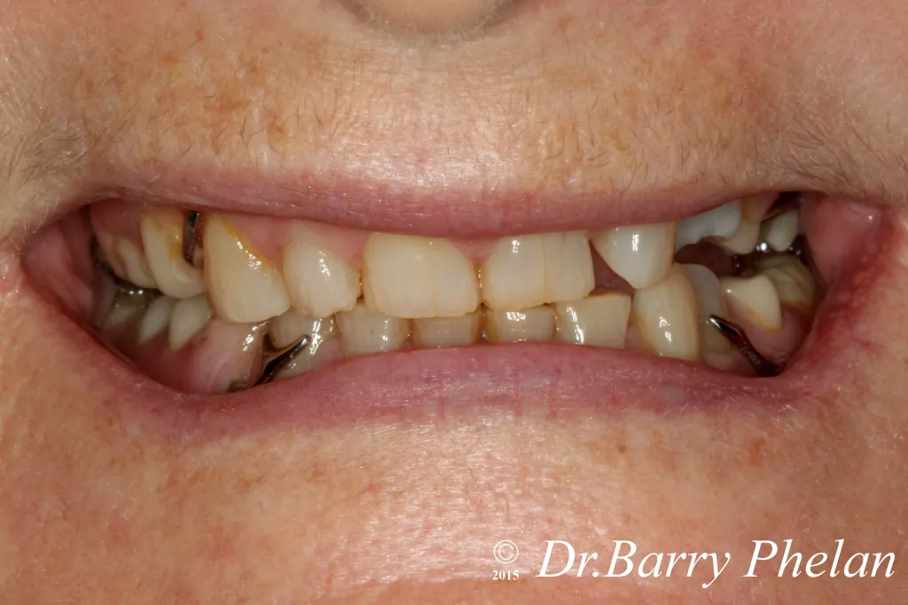 Resin Veneers to correct wear from Bruxism