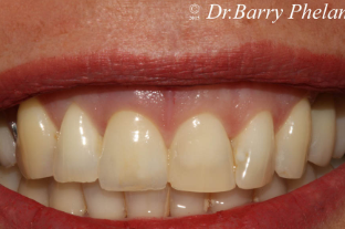 Immediate Implant to Replace Central Incisor