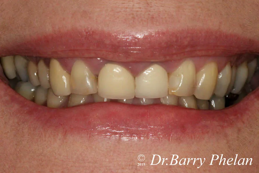 Smile Rehabilitation with Implant Therapy, Crown Lengthening