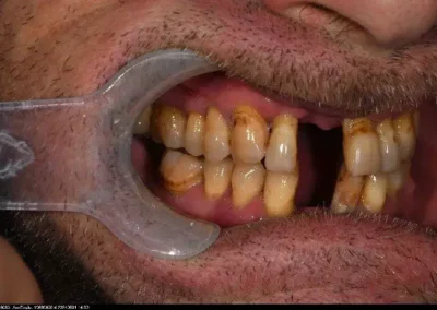 Full Mouth & Smile Rehabilitation with Orthodontics, Implants