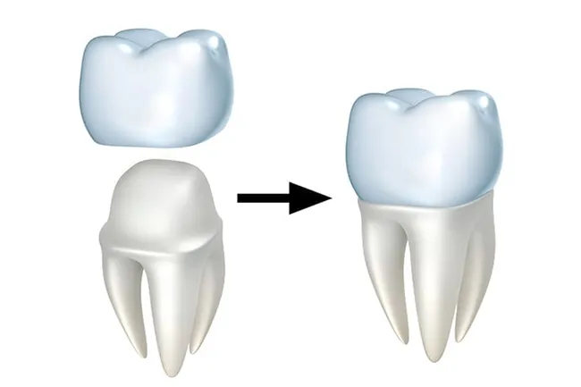 Traditional veneers require the preparation and grinding down of your original teeth.