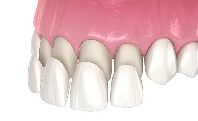 Dental veneers are thin, tooth-coloured shells that are attached to the front surface of teeth.