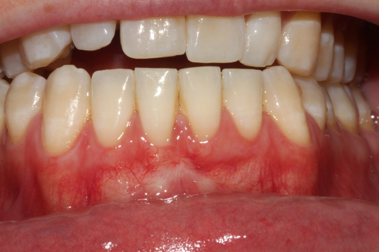 Repair of severe recession with Alloderm Graft